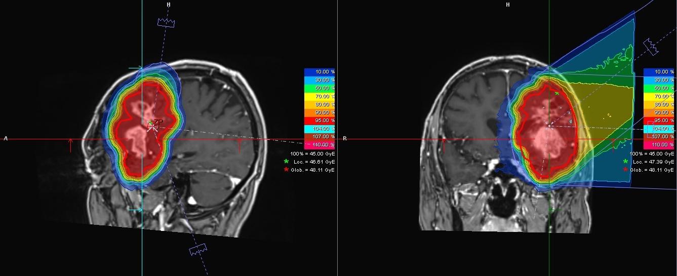Zwei MRT-Aufnahmen eines Patienten mit Glioblastom