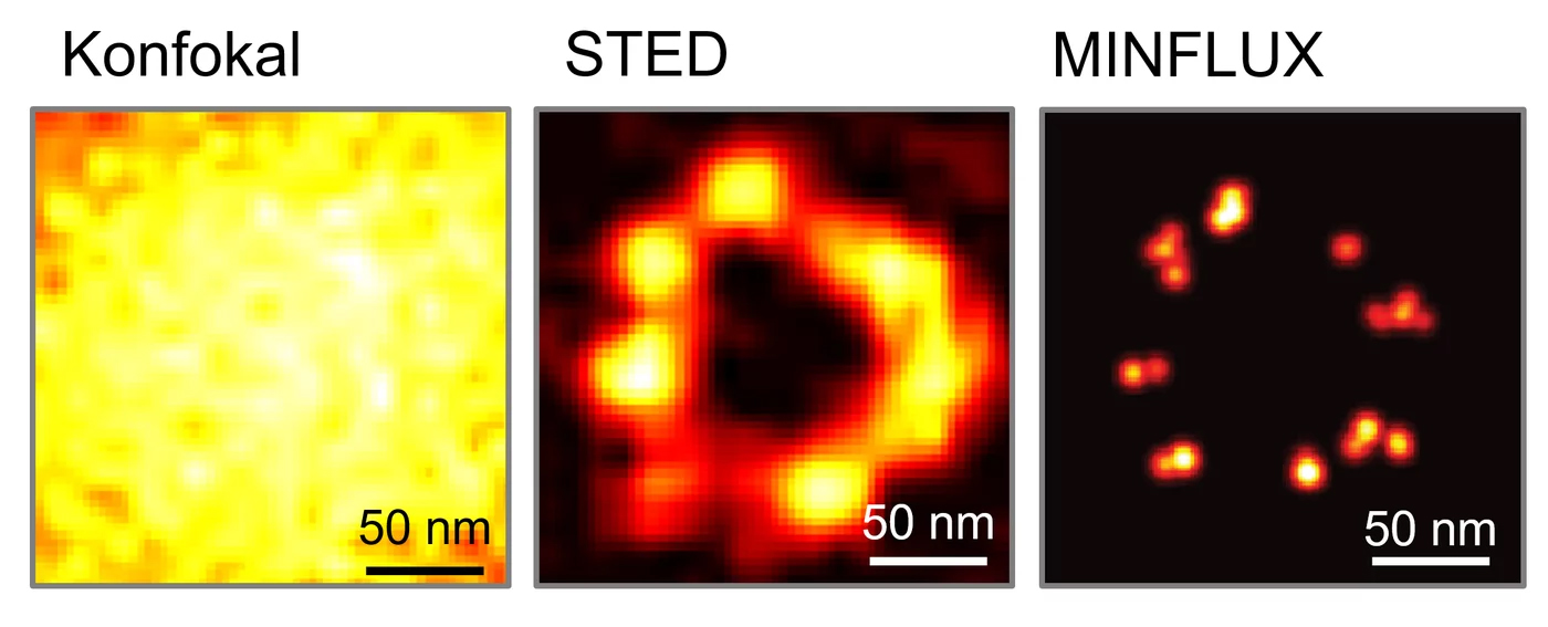 On the left microscope image, only one image-filling yellow spot is visible, in the middle image, several circularly arranged, merging yellow dots can be seen, which are outlined in red, and on the right, small, quite clearly delineated yellow dots with a red outline can be seen.