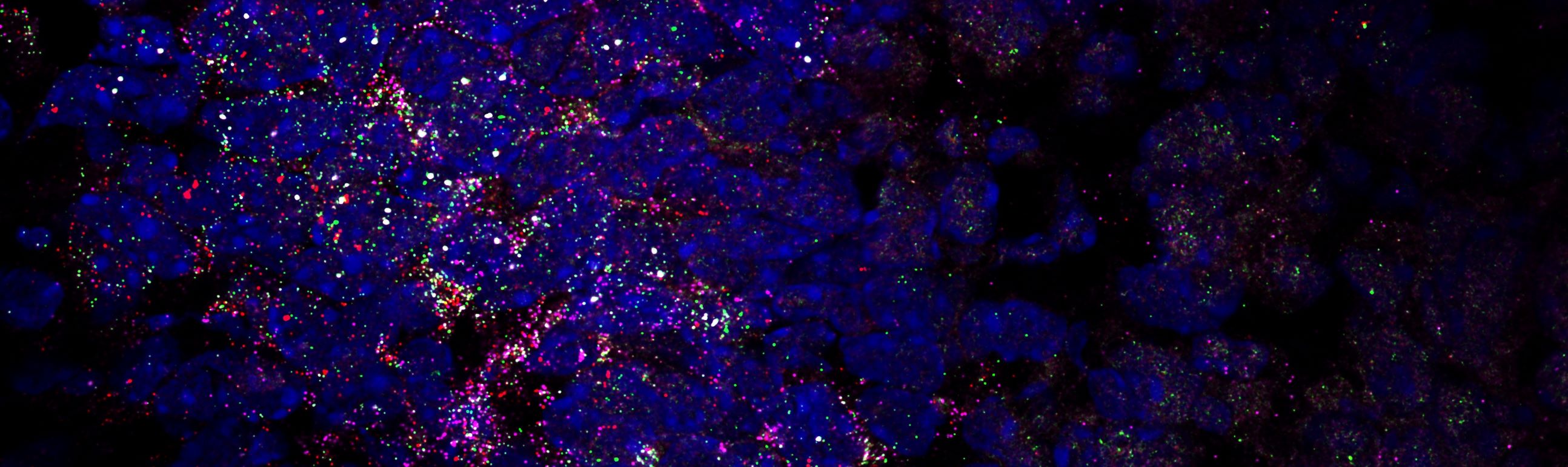 Fluoreszenzmikroskopische Aufnahme einer Hulu-FISH-Analyse. Zu sehen sind bunt leuchtende Bildpunkte und Farbflächen auf dunklem Hintergrund.