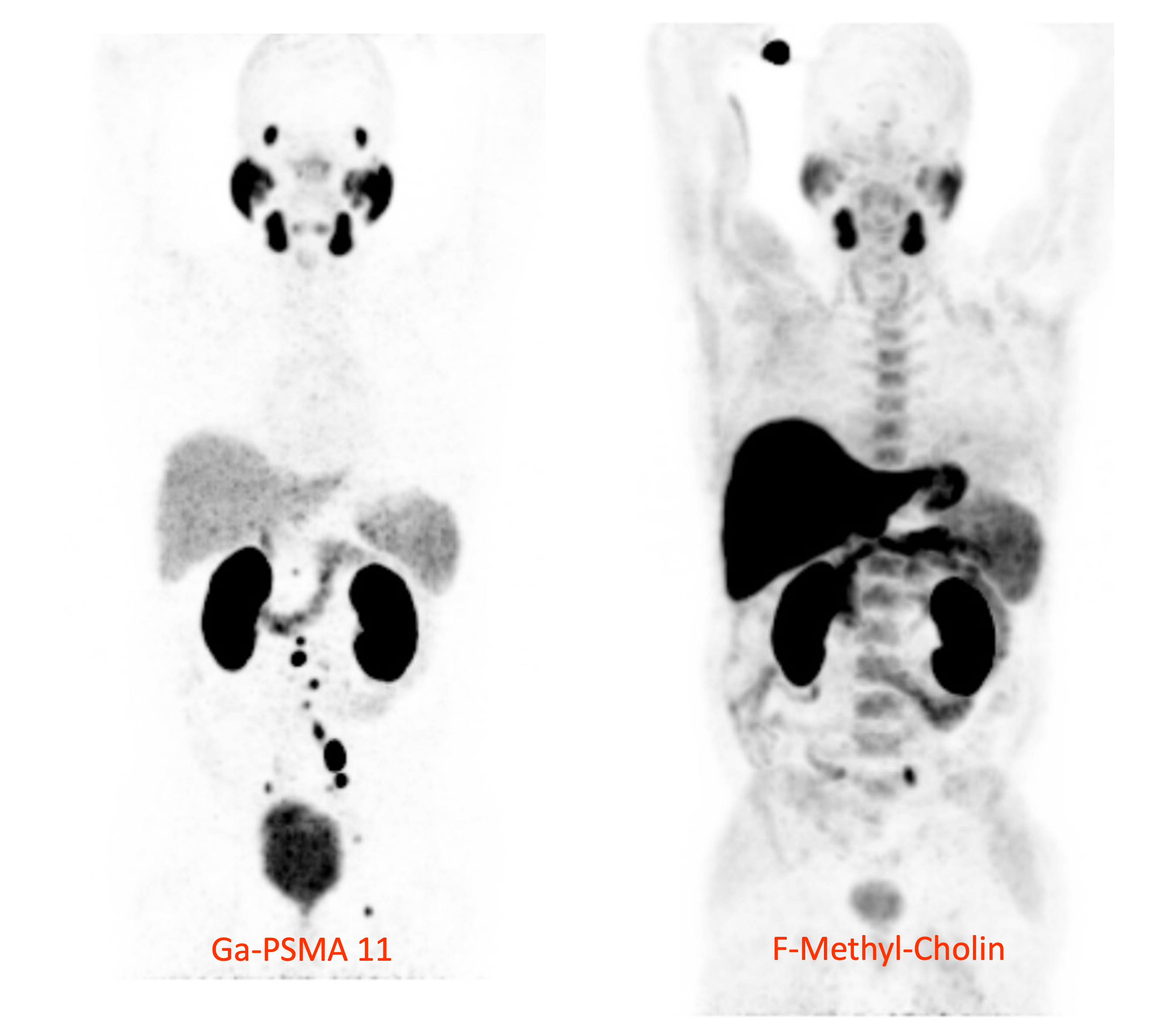 Radiodiagnostics of prostate cancer by positron emission tomography