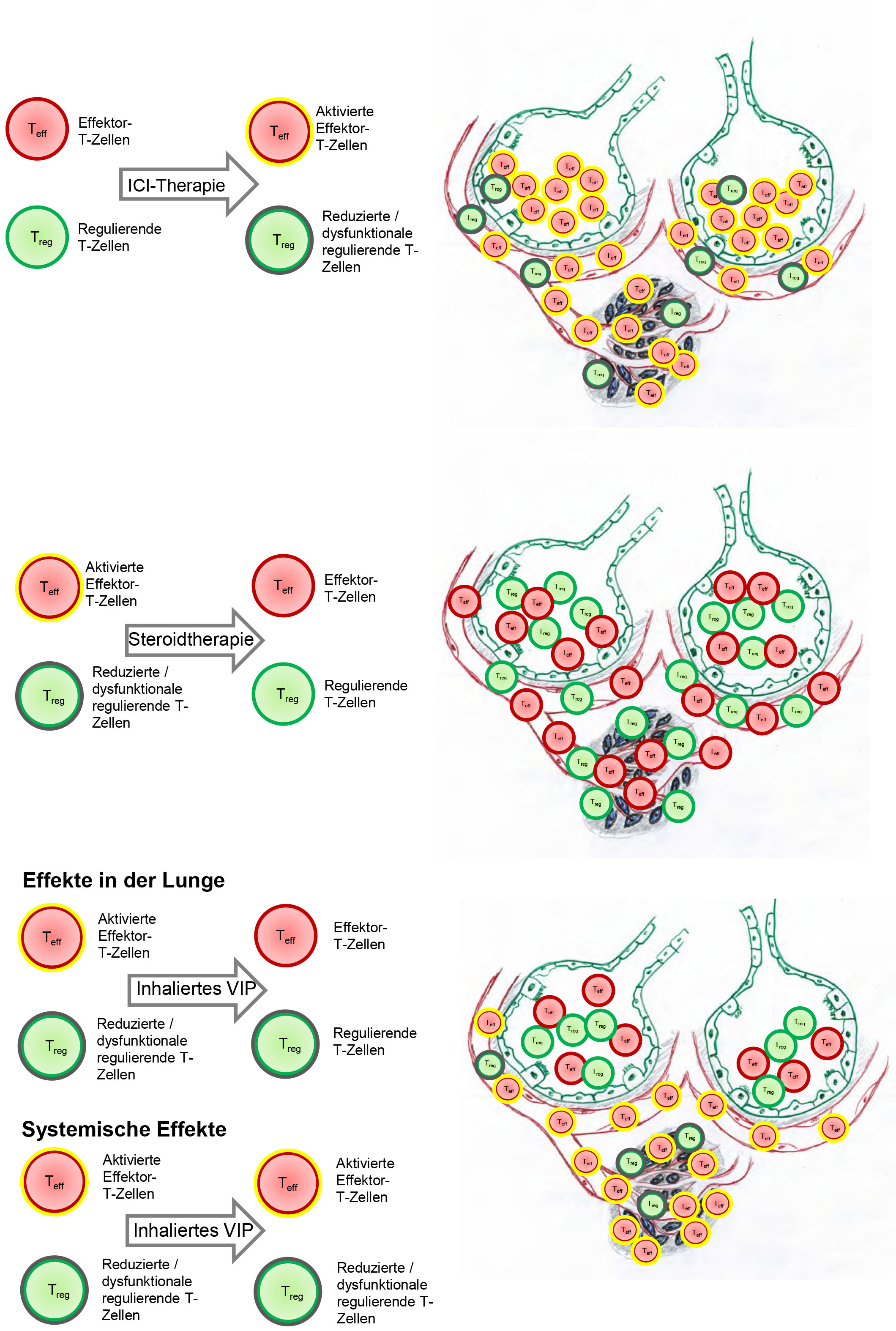 ICI (immune checkpoint inhibitor) immunotherapy activates effector T cells and conversely reduces the number of regulatory T cells in order to defeat the tumour (black cells). Pneumonia triggered by immunotherapy is treated with steroid therapy (cortisone) or with inhaled VIP (vasoactive intestinal peptide). VIP treatment attenuates the inflammation.