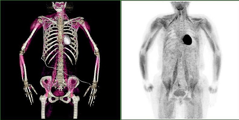 PET/CT image of the heart muscle