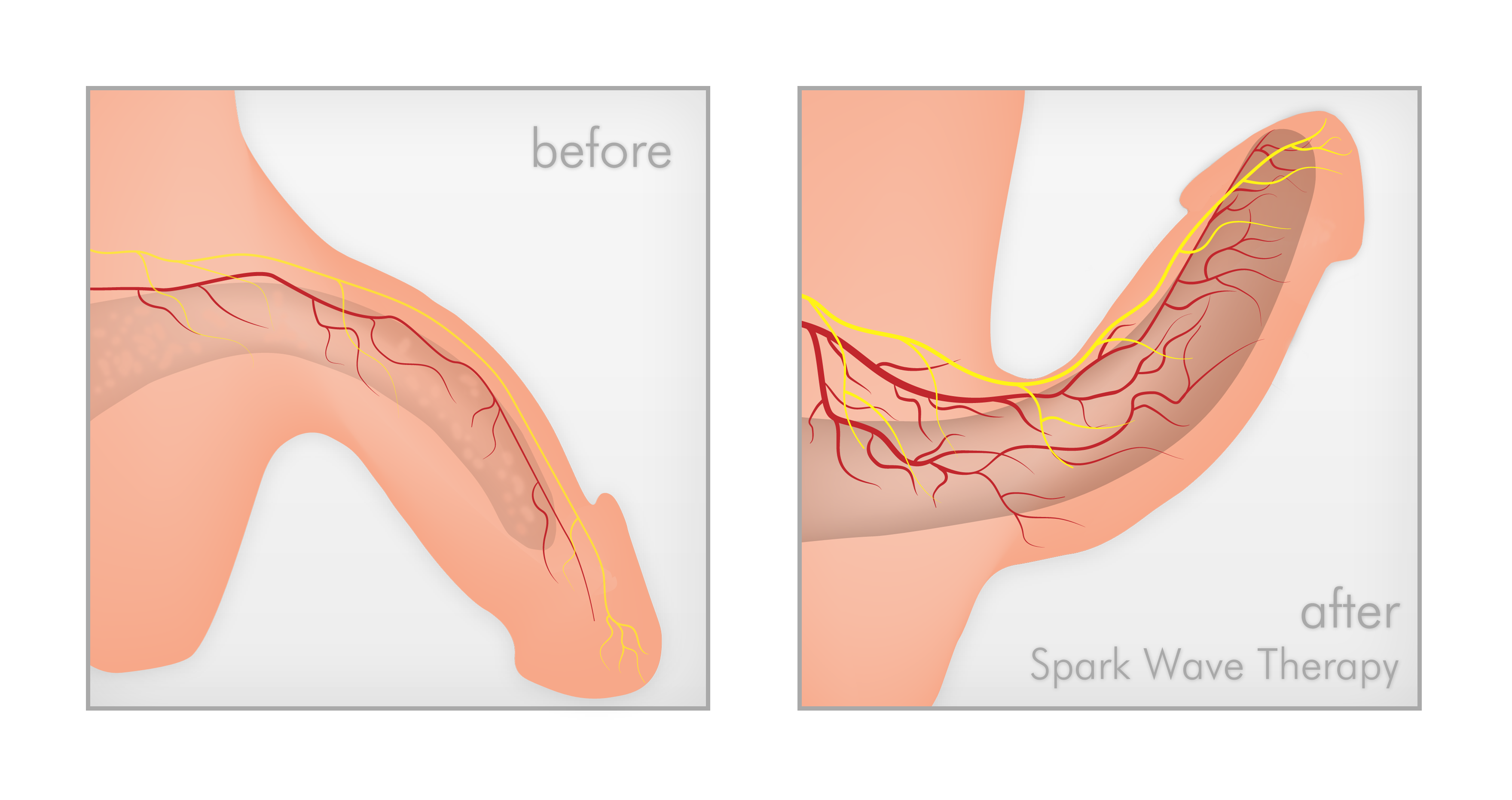 Implantat penis Penilný implantát