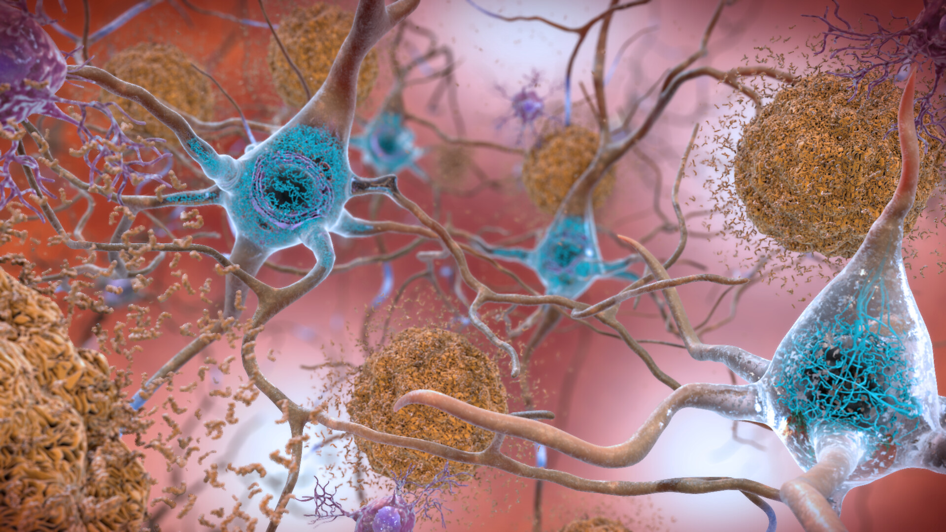 Illustration of several neurones with long cell processes between which spherical beta-amyloid aggregates are located. The cell bodies are interspersed with P-tau fibrils.
