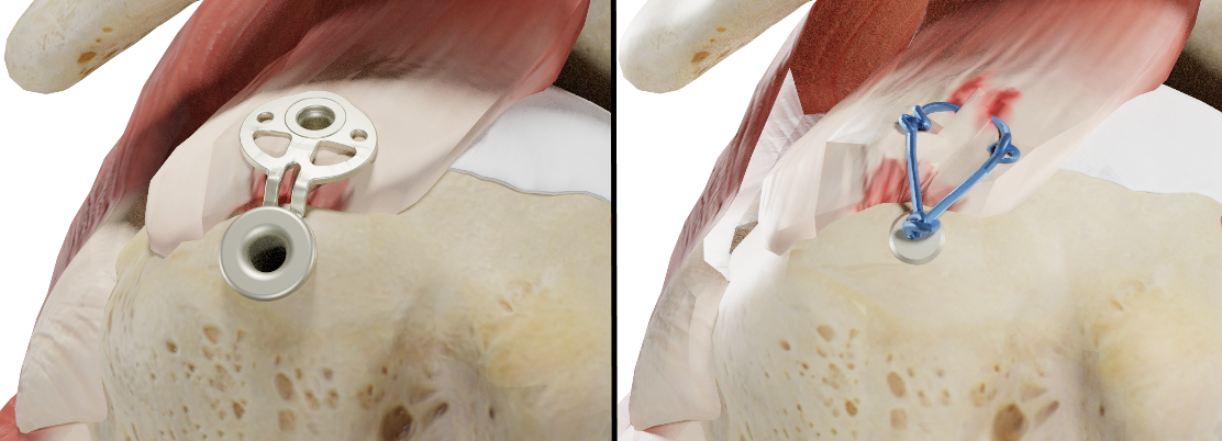 Zwei Abbildungen mit jeweils dem gleichen Schulterknochen und Muskel: links fixiert mit grauem SINEFIX, rechts mit blauen Fäden und Knoten.