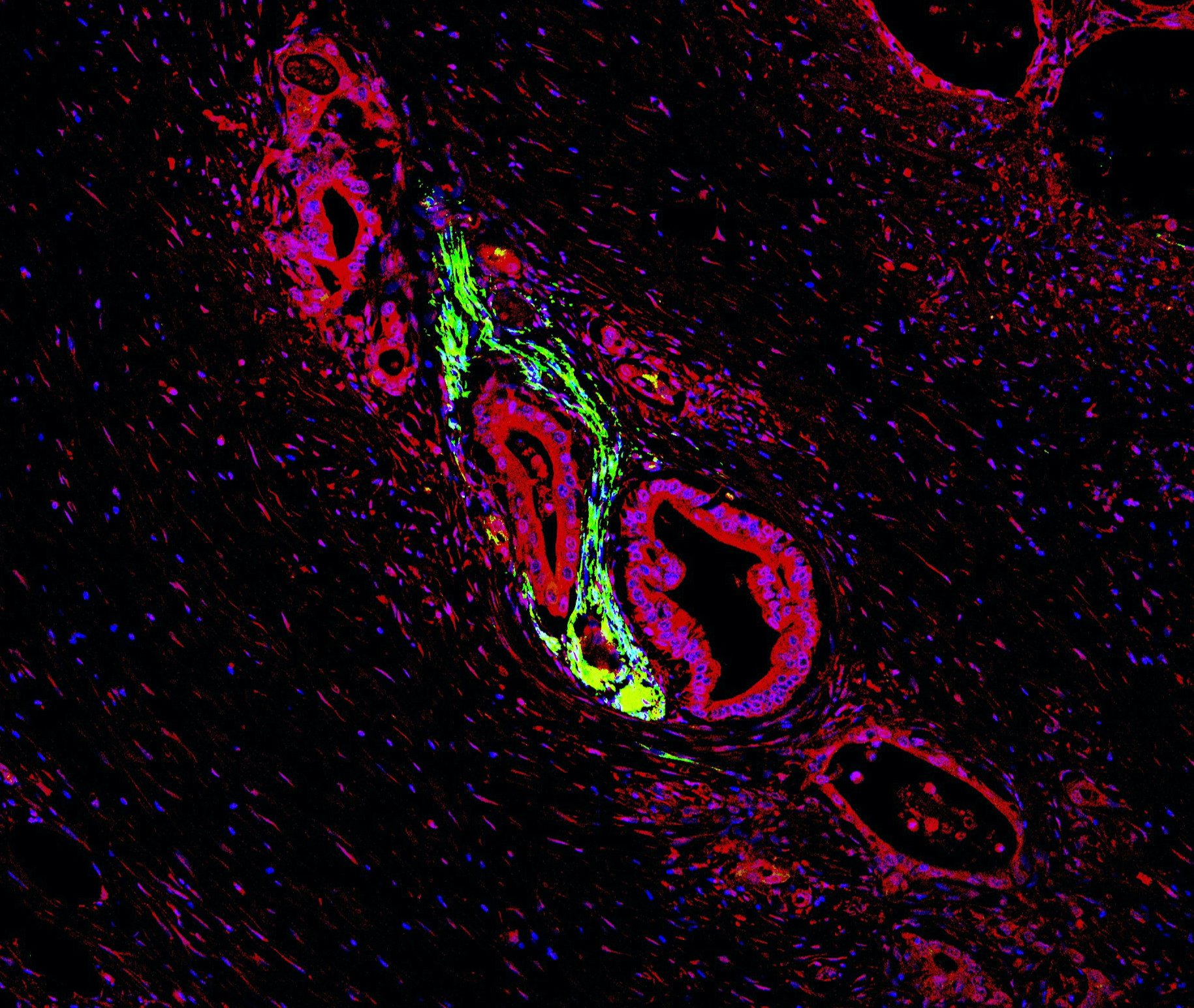 Das Foto zeigt einen Gewebeschnitt, auf dem immunhistologisch angefärbte angefärbte Pankreaskarzinomzellen