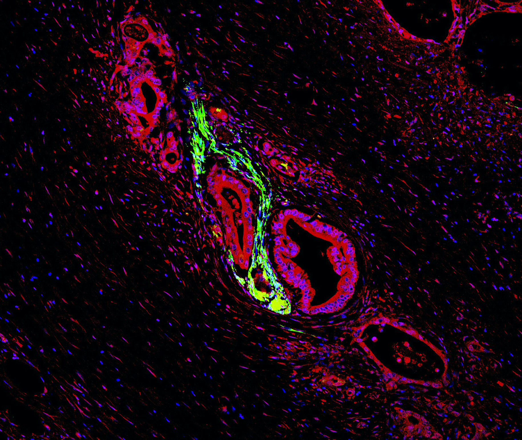 The photo shows a tissue section on which immunohistochemically stained pancreatic carcinoma cells are shown