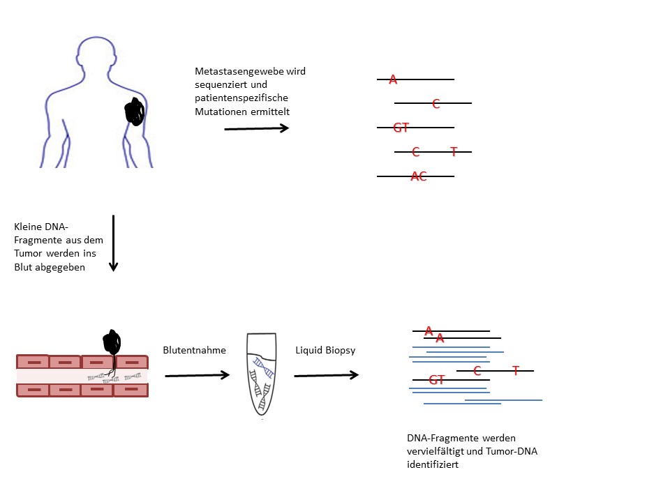 Schematische Darstellung der Vorgehensweise bei der Liquid Biopsy. Nach der Ermittlung patientenspezifischer Mutationen kann die Tumor-DNA anhand dieser Mutationen aus Blutproben identifiziert werden.