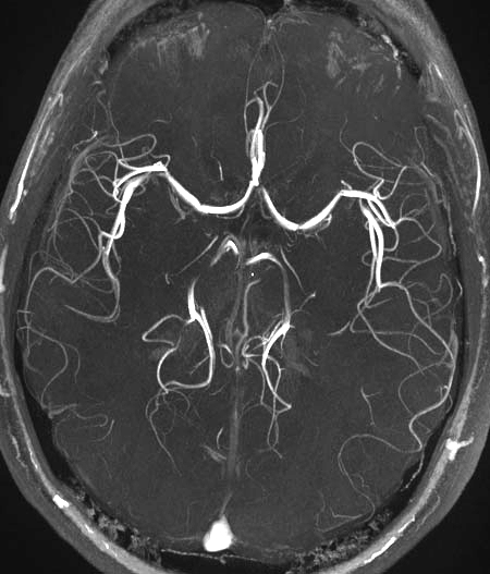 Magnetic resonance angiography (TOF-MRA) of blood vessels in the brain