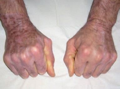 The photo shows the result of applying Suprathel® to a wound caused by electricity for a period of eight months. The skin has regenerated well.