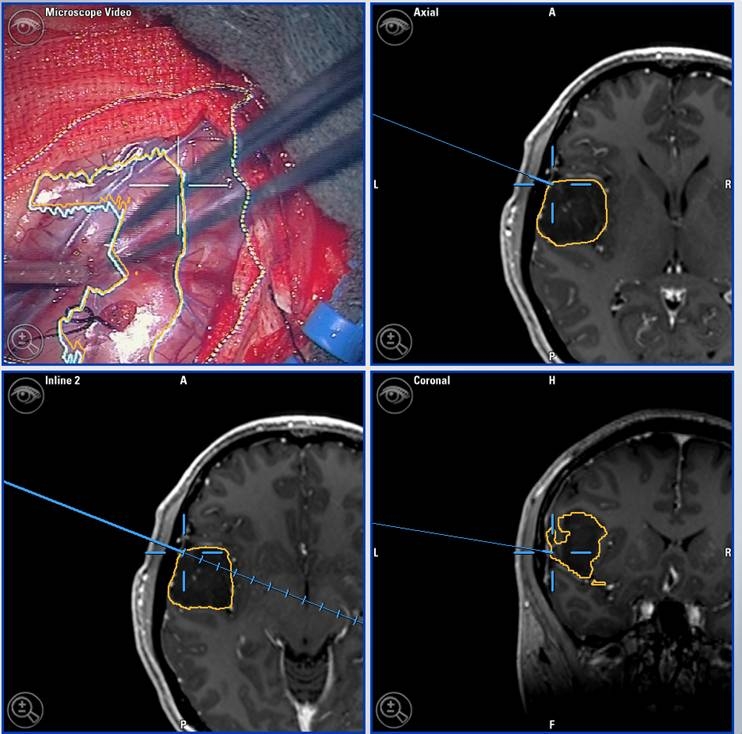 Brain surgery not only involves surgical microscopes (top left), but also allows the surgeon to receive anticipation data blended into his eye.