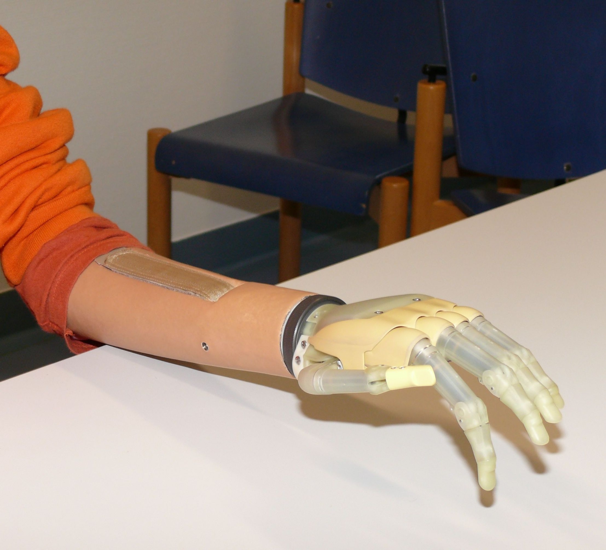 The bionic hand “I-Limb” of the Scottish company “Touch Bionics” (Photo: Hospital of Orthopaedics at Heidelberg University)