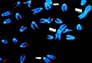 In der mikroskopischen Aufnahme sind blau markierte Chromosomen zu sehen. Einige der Chromosomen haben rotmarkierte Enden (Telomere). Bei einigen fehlt die rote Markierung, weil die Telomere stark verkürzt sind.