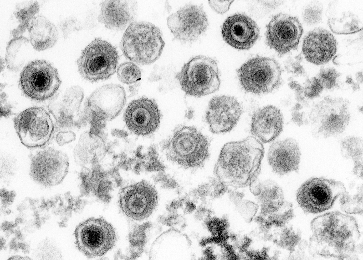 Electron microscope image of Epstein-Barr viruses. The photo shows spherical viral shells with content.