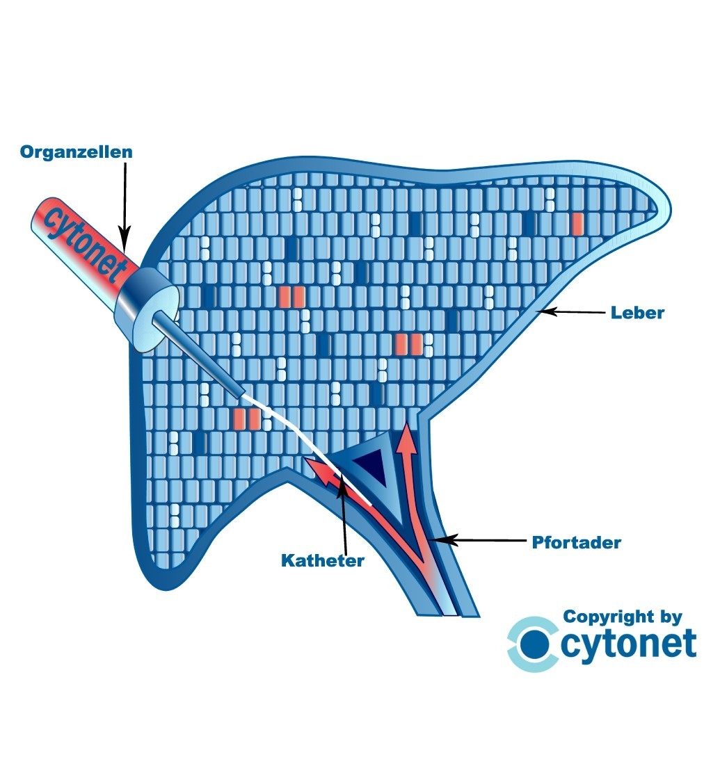 Schematische Darstellung der Infusion von Leberzellen zur Zelltherapie (Abbildung: Cytonet)