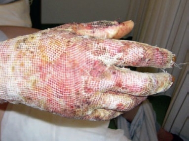 Photo of a hand with burns caused by electricity, after six days’ Suprathel® application. The photo shows the vast burn areas covered by the Suprathel® and gauze.