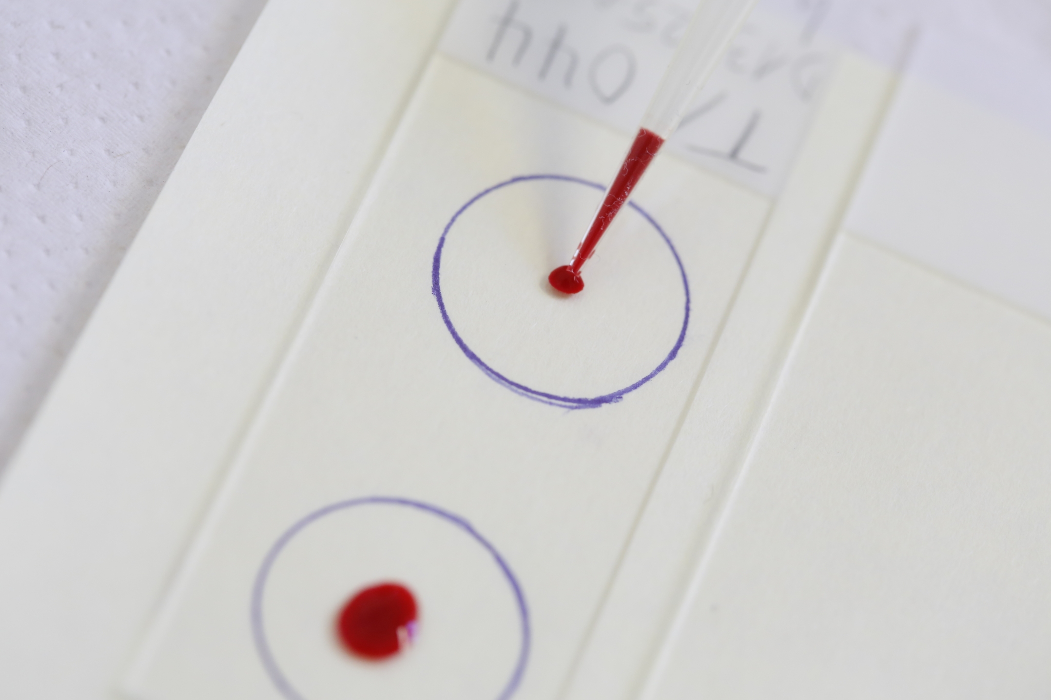 Foto eines Kunststoffplättchens, auf das zur Diagnose von Malariaparasiten mit einer Pipette Blut aufgetropft wird.