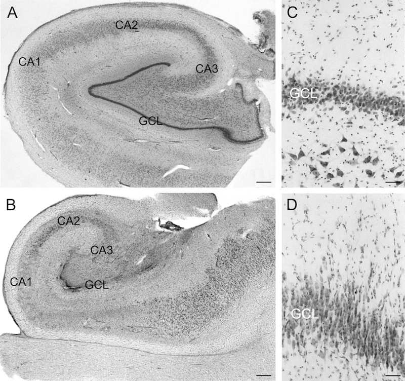 The figure shows four black and white photos: top left: wound structure of a healthy human hippocampus, top right: magnified band of black cell nuclei, bottom left: distorted structure in the epileptic human hippocampus; bottom right: broader band of blac