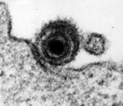 Electron microscope image of an EBV particle on the surface of a lymphocyte.