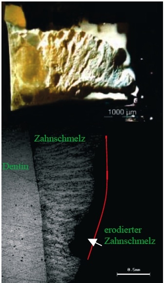 The photo shows a close-up of a tooth; dentin, enamel and eroded enamel are associated with green letters; the eroded enamel area is marked with a white arrow.