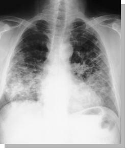 Röntgenaufnahme_Entzündete Lunge