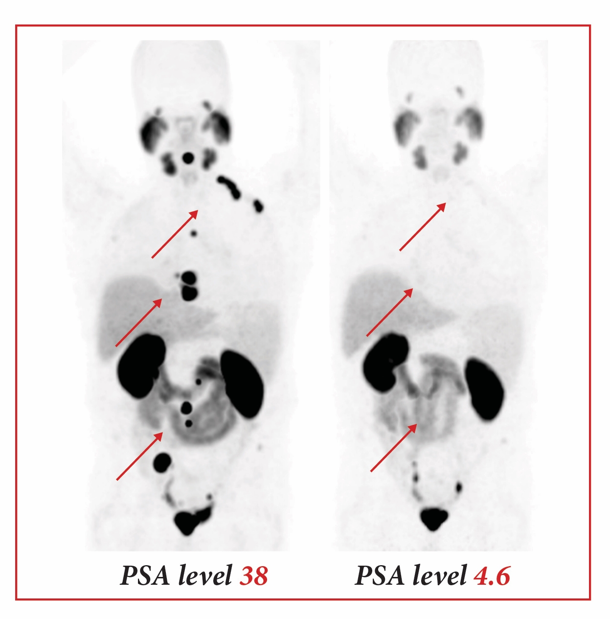 Illustration of PSMA-617 endoradiotherapy success in treating prostate cancer. PET image illustrating the remission of prostate cancer following radiotherapeutic treatment with PSMA-617. The figure shows two PET images, one prior and one after treatment.
