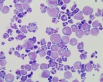 Microscope image of cancer cells that have been exposed to UV light.