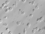 Glioblastoma cells with a granular appearance that indicates that they have undergone apoptosis. Cell death can be induced by the addition of methadone.