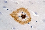 Micrograph of a nerve cell of a Alzheimer's patient. The toxic beta-amyloid aggregations, which are responsible for the disease, are stained brown.