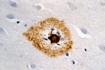 Micrograph of a nerve cell of a Alzheimer's patient. The toxic beta-amyloid aggregations, which are responsible for the disease, are stained brown.