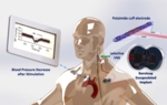 Schematic showing how the neurostimulator leads to the stimulation of the vagus nerve lowers the blood pressure.