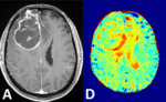 Zwei verschiedene Querschnittaufnahmen eines Gehirns. Links ist die Darstellung eines Hirntumors mit konventioneller, kontrastmittelverstärkter MRT. Rechts die Glukose-MRT Bildgebung bei 7 Tesla.