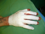 Eine Membran aus Milchsäure liegt auf der geschädigten Haut einer Hand. Die Membran schützt die geschädigten Flächen und ermöglicht darunter eine narbenfreie Abheilung.