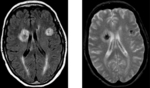 Zwei MRT-Aufnahmen (schwarz weiß) des Gehirns eines Patienten mit cerebraler Aspergillose. In der oberen Bildhälfte sind zwei annähernd runde Strukturen zu erkennen (rechts hell, links dunkel), sie  kennzeichnen den Pilzbefall.