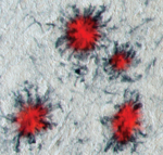 Amyloid plaques (red) surrounded by microglia (blue-black).