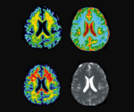 Dargestellt sind vier unterschiedliche MRT-Querschnitte des menschlichen Gehirns.