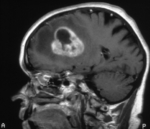 Zu sehen ist eine Kernspinaufnahme eines menschlichen Kopfes. Im Gehirn ist ein walnußgroßes weißes Gebilde.