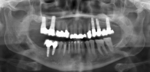 Zu sehen ist eine Röntgenaufnahme eines Kiefers von vorne, im Kieferknochen sieht man in Weiß zahlreiche Schrauben und darauf sitzende künstliche Zähne.