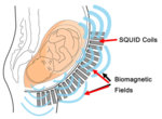 Schematische Darstellung des Messprinzips beim fMEG. Links der Querschnitt
durch den Bauch einer Schwangeren mit dem eingezeichneten Fötus, rechts die
Messeinheit mit den Sensoren der fMEG-Schale. Hellblaue Bögen, die sich vom
Bauch der Schwangeren aus nach rechts ausbreiten, symbolisieren die
Magnetwellen, die von dem Fötus ausgehen und aufgezeichnet werden können.