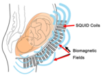 Schematic representation of the fMEG measurement principle. Left: cross-section through the abdomen of a pregnant woman, showing the foetus; right: measurement unit with the sensors of the fMEG shell. 
The light blue lines running from the belly of the pregnant woman to the right-hand side symbolise the magnetic waves that originate from the foetus and which are recorded.