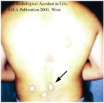 The photo shows a male person with back exposed. A couple of white spots can be seen in the tailbone area. A black arrow points towards one of these spots.<br />