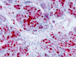 Section of a malignant skin tumour in Mastomys coucha. Dividing tumour cells are stained red.