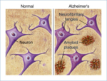 Im Gehirn von Alzheimer-Patienten klumpt Abeta zu unlöslichen Amyloid-Plaques zusammen. Quelle: American Health Assistance Foundation