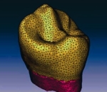 Zu sehen ist ein 3D-Berechnungsmodell eines Prämolaren.
