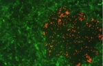 Rot fluoreszierende, partikuläre Tumorsonden binden auf stark entartete kultivierte Darmkrebszellen.
