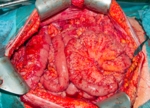 The tumours can be removed using peritonectomies with HIPEC.