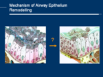 Restructering processes of epithelial cells occuring as the result of respiratory diseases. Model.<br />