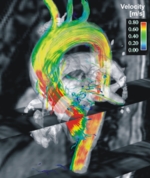 Normal blood flow in the aorta. MRI also reveals pathological changes and enables the early prognosis of cardiovascular diseases.
