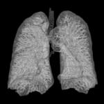 Zu sehen sind die zwei Flügel einer menschlichen Lunge mit feinen Verästelungen