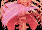 Zu sehen ist eine tomographische, rot und rosa gefärbte Aufnahme der Organe in einem Oberkörper. Die Leber ist in rosa.